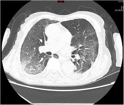 Case Report: Canakinumab for the Treatment of a Patient With COVID-19 Acute Respiratory Distress Syndrome